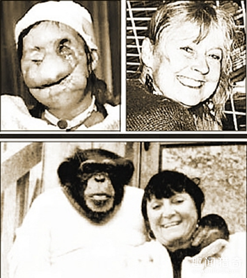 美国56岁女子遭黑猩猩袭击成无脸人成“魔鬼容貌”